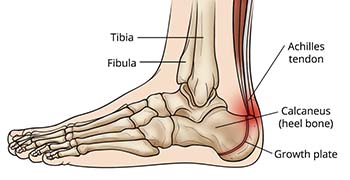 Heel pain relief treatments for plantar fasciitis and heel spurs